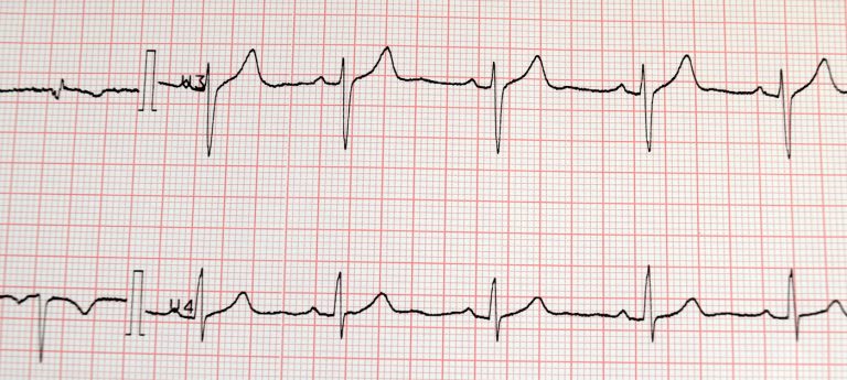 ekg 768x345